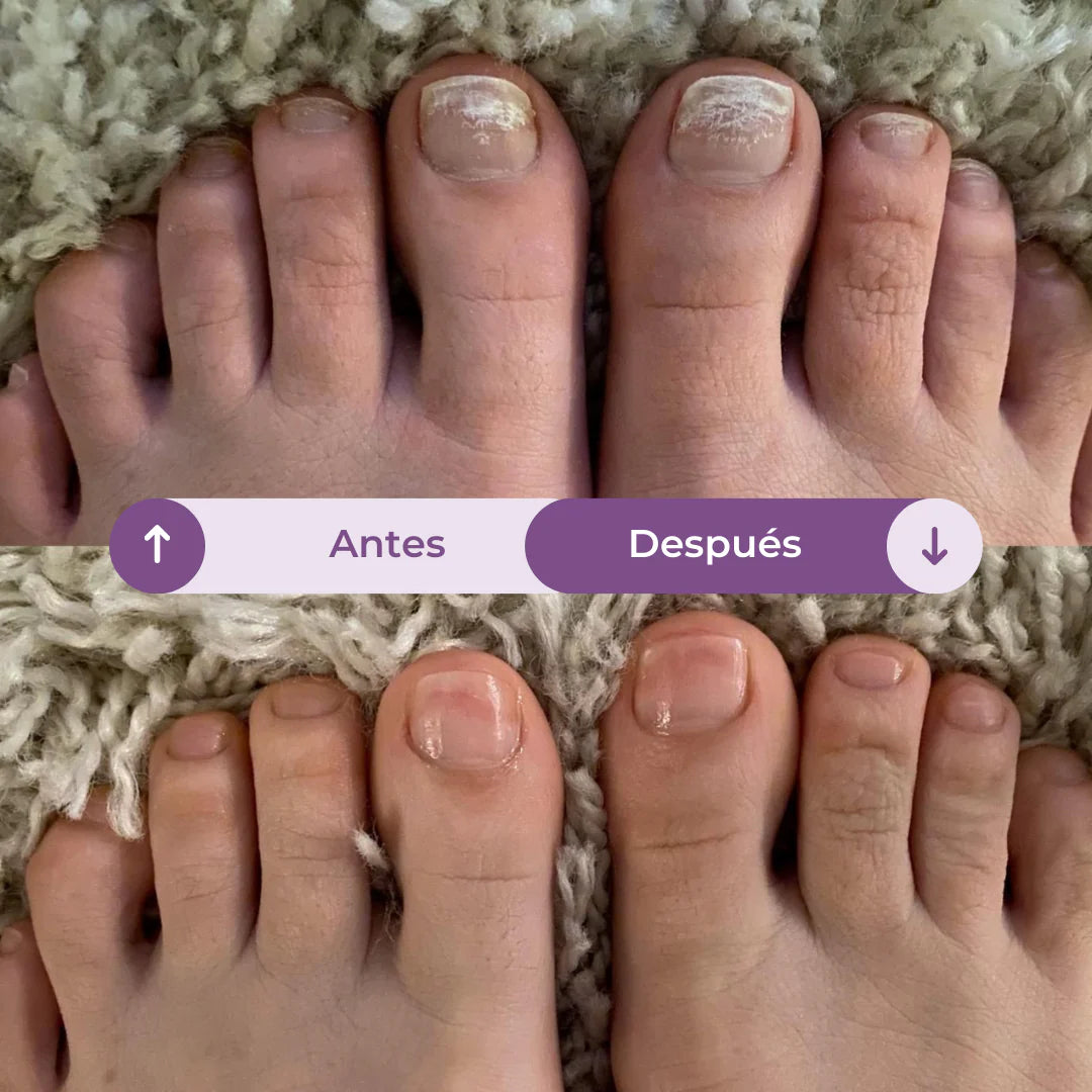 7 Days | Elimina hasta el 99.9% de los hongos en tus uñas.