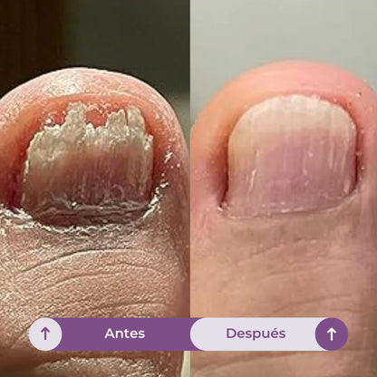 7 Days | Elimina hasta el 99.9% de los hongos en tus uñas.